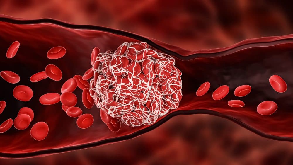 Long COVID: Coagulopathies and Microclots