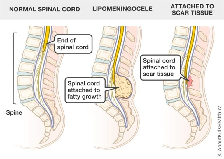 Tethered Cord Syndrome Diagram